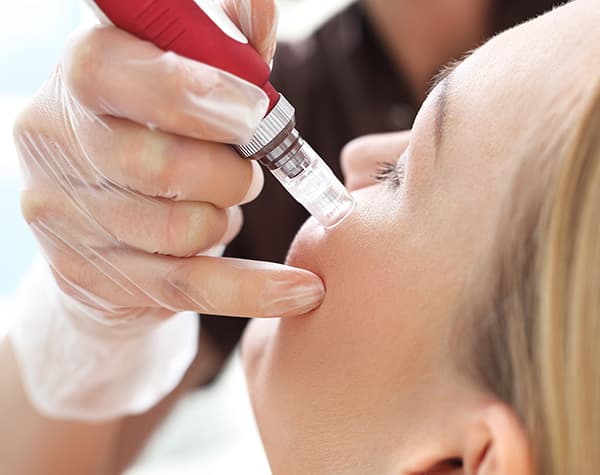 Woman getting microneedling treatment