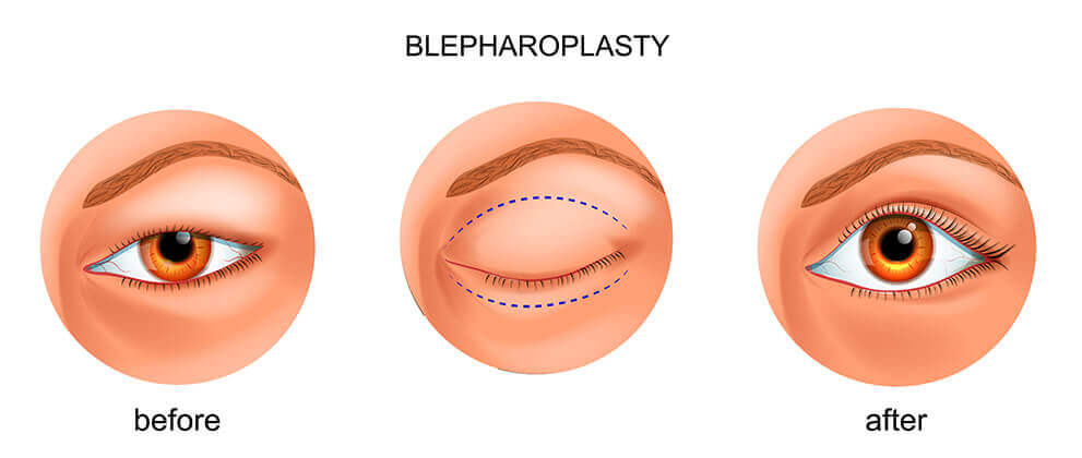 Blepharoplasty Before and After Diagram