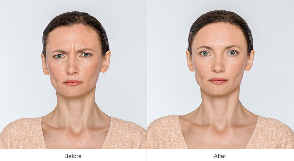 Before and After Botox Treatment