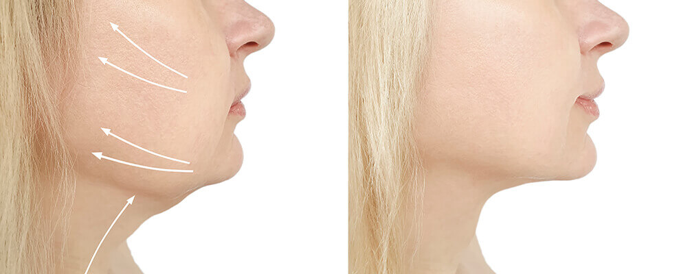 Chin Laser Treatment Before and After