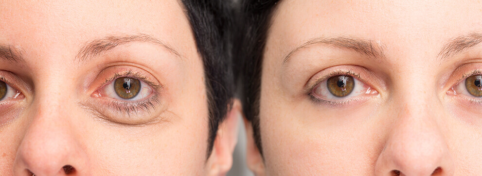 Lower Eyelid Surgery Before and After