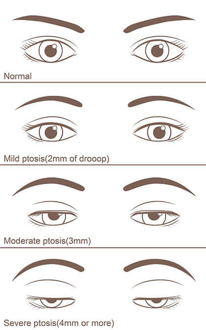 Ptosis Stages Chart
